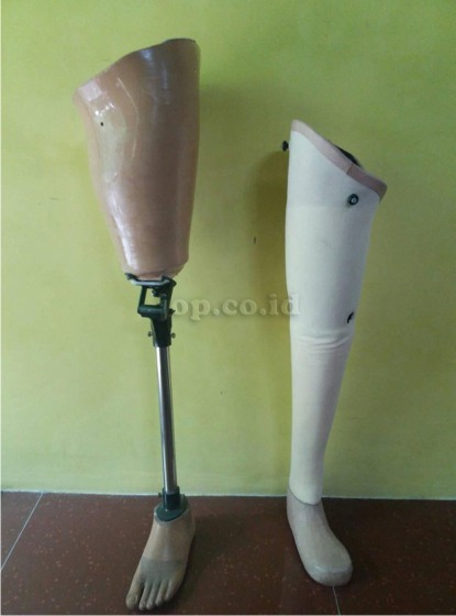pengguna kaki palsu di Banyuwangi